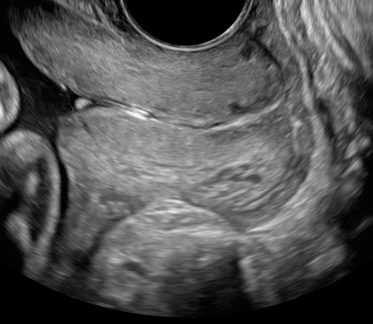 Cervix
