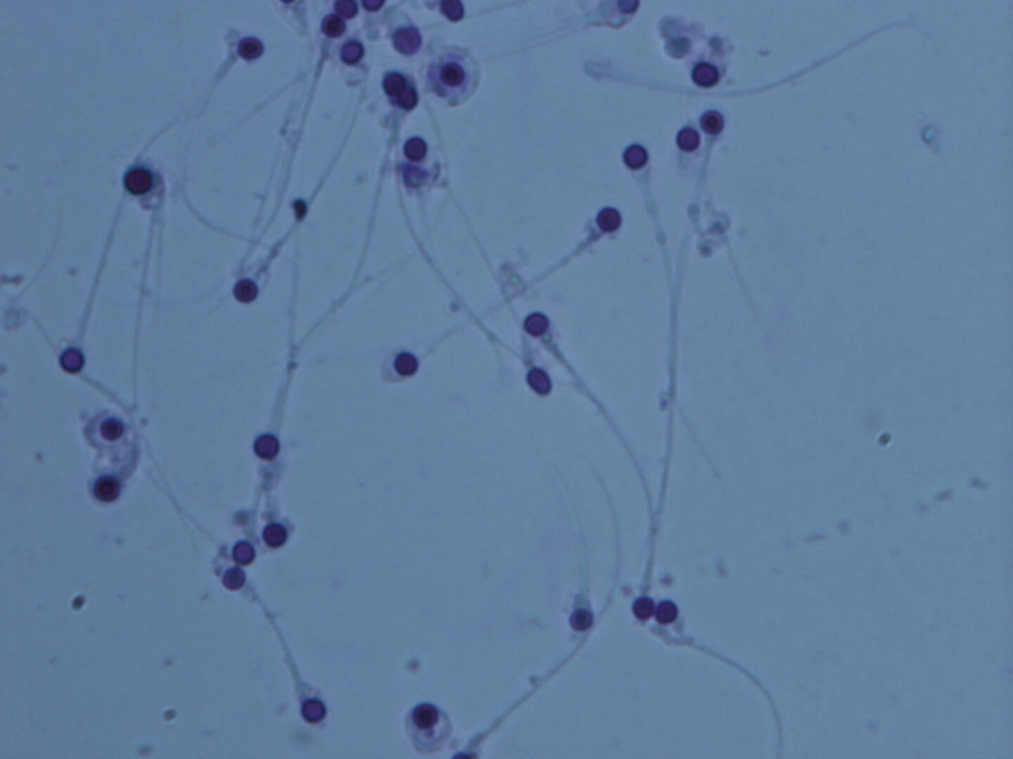 Globozoospermia