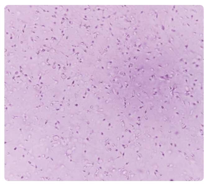 Normozoospermia