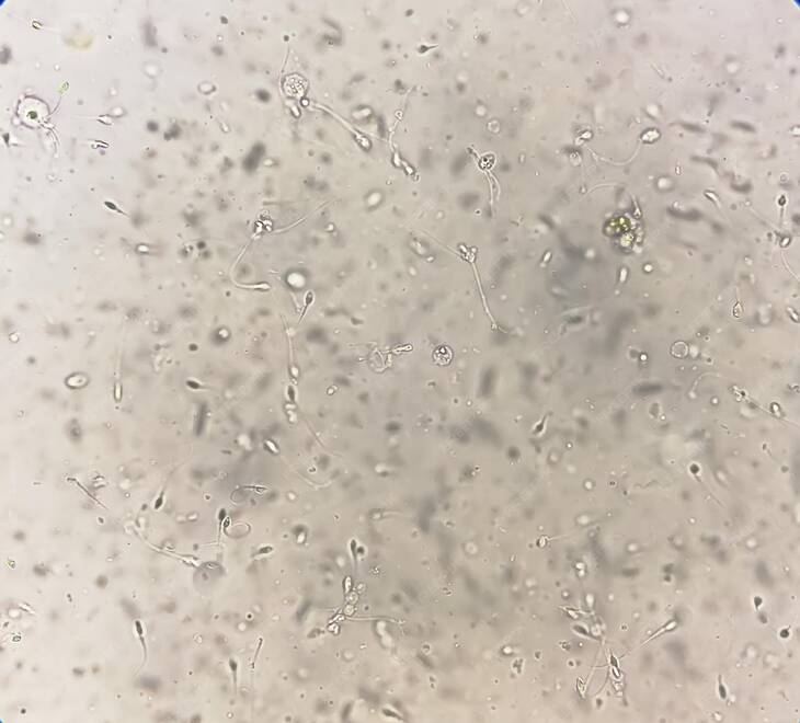 Screenshot 2025-09-07 at 16-24-48 Semen analysis under microscopy showing pyospermia or leukocytospermia. sperm analysis. Premium Photo