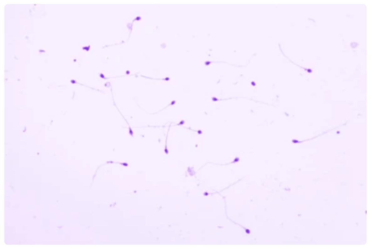 oligozoospermia