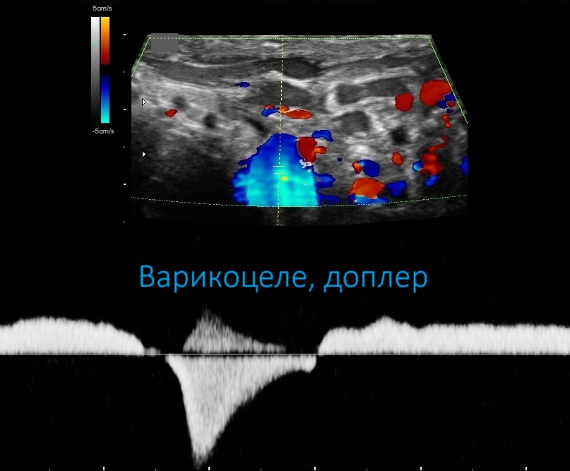 varicocele